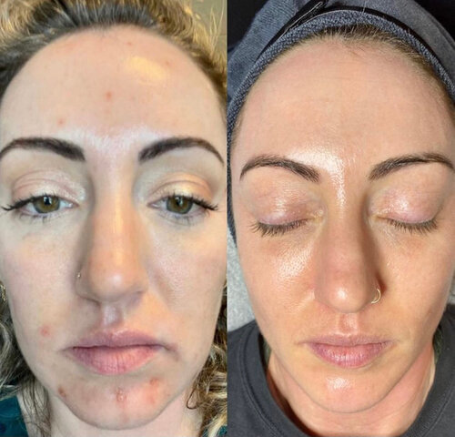 before and after vi peel